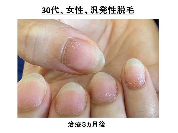 円形脱毛症　病院
